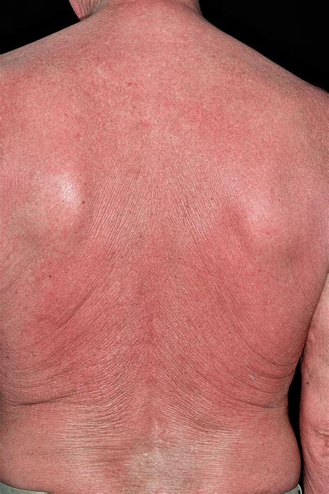 Rash On Back After Cancer Treatment Photograph By Dr P Marazzi Science