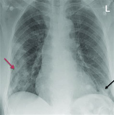 Chest X Ray Shows Right Subpleural Peripheral Heterogeneous Opacities