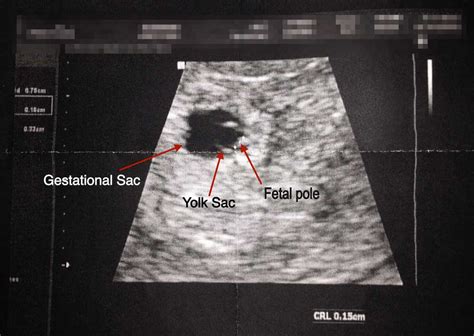 Pregnancy 5 Weeks Ultrasound Pregnancywalls