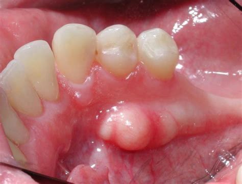 Bump On Gums Causes And How To Treat Them