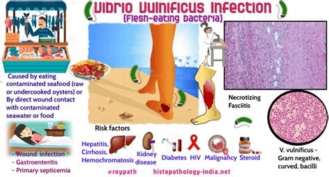 Top Ten Facts About Pathology Of Vibrio Vulnificus Dr Sampurna Roy Md