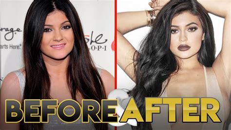 Kylie Jenner Before And After Transformation Lips Plastic Surgery