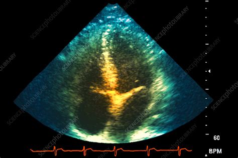 Normal Heart Ultrasound Scan Stock Image P2160476 Science Photo