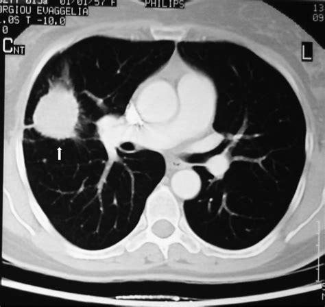Cryptogenic Organizing Pneumonia Mimicking Malignancy In A Patient With