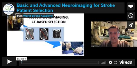 Basic And Advanced Neuroimaging For Stroke Patient Selection World