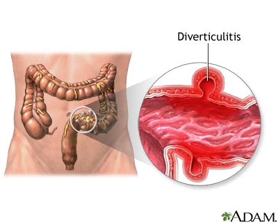 Diverticulitis MedlinePlus enciclopedia médica illustración
