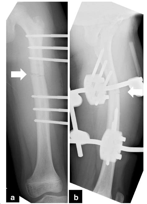 Radiographs Of The Left Femur After The First Closed Reduction And