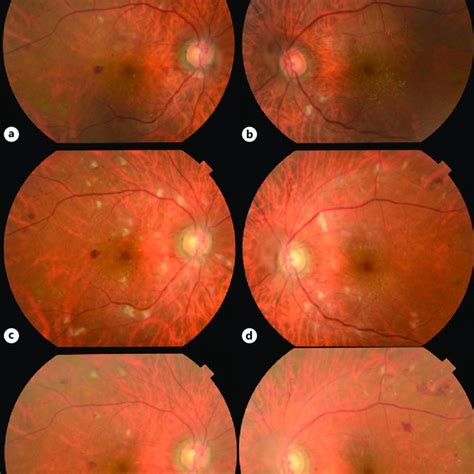 Color Fundus Photograph Findings In Both Eyes Of Our Patient During