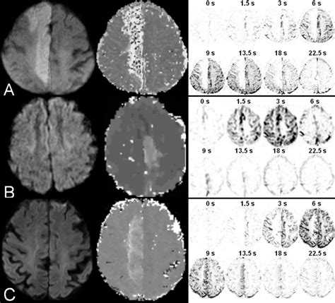 Examples Of Diffusion Weighted Left Corresponding Perfusion Weighted