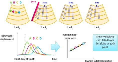 Principle Of Working System Shear Wave Elastography Generates Push