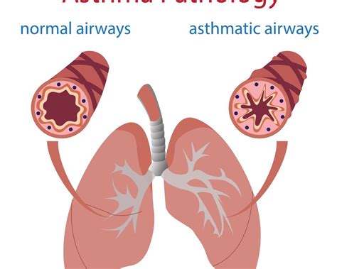 What Is Lung Disease Caused By Asthma Lung Disease Images