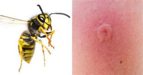 12 Common Bug Bites And How To Recognize Each One