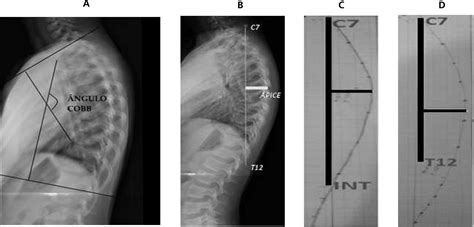 Scielo Brasil Kyphosis Index Obtained In X Ray And With Flexicurve