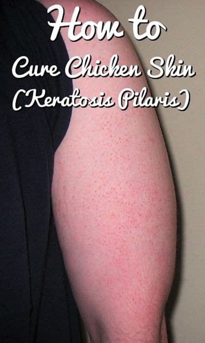 Home Remedies For Keratosis Pilaris Bumps On The Skin Chicken Skin