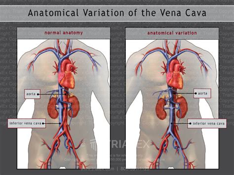 Anatomical Variation Of The Vena Cava Trial Exhibits Inc