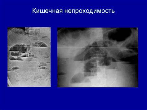 Непроходимость Кишечника Симптомы У Взрослых Диета — Похудение Диета Картинка - Непроходимость Кишечника Симптомы У Взрослых Диета — Похудение Диета