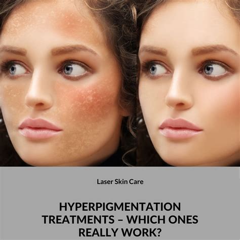 Hyperpigmentation Treatments Which Ones Really Work In 2021