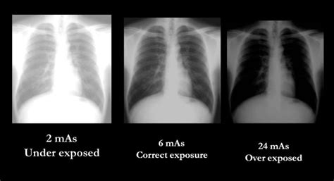 Chest X Ray What Makes A Good Image My Own Rad