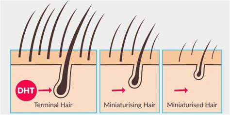 Hair Restoration For Early Hair Loss Innovations Medical