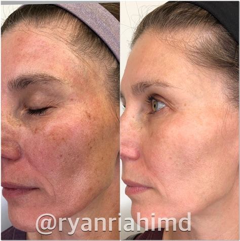 Intense Pulsed Light Ipl Before And After Photos Patient 48 Houston