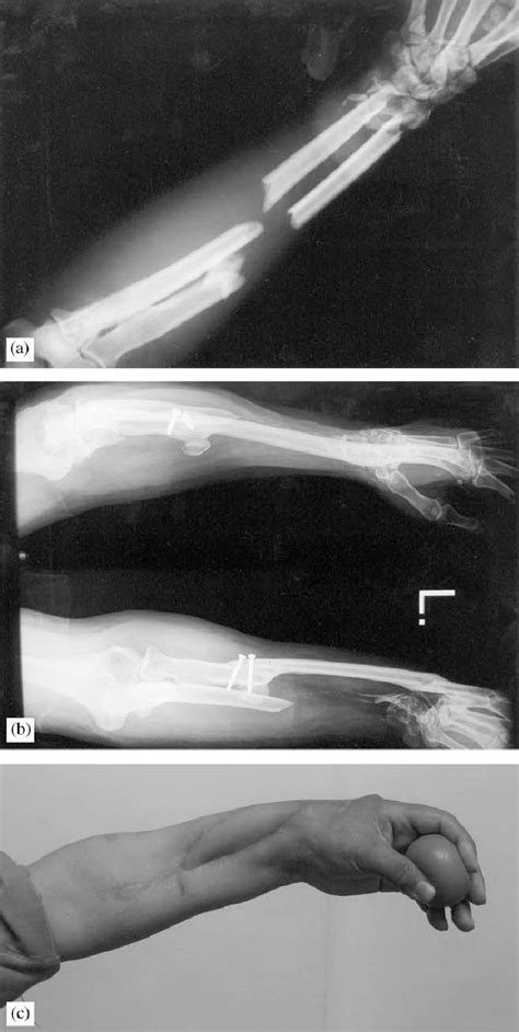 Case 2 A Pre Operative Radiograph Showing Destruction Of The Wrist