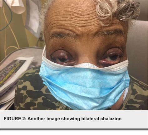 Figure 2 From A Case Report On Bortezomib Induced Bilateral Chalazion