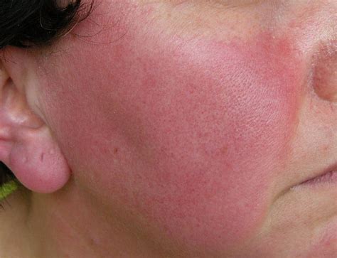 Red In The Face We Look At Rosacea And Treatments That Work Blue