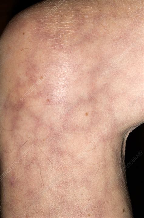 Livedo Reticularis Vascular Disorder Stock Image M3200433