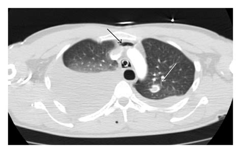 Figure 1 Stab Injury Of The Thoracic Aorta Computed Tomography Findings