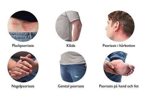 Psoriasis Amgen Sverige