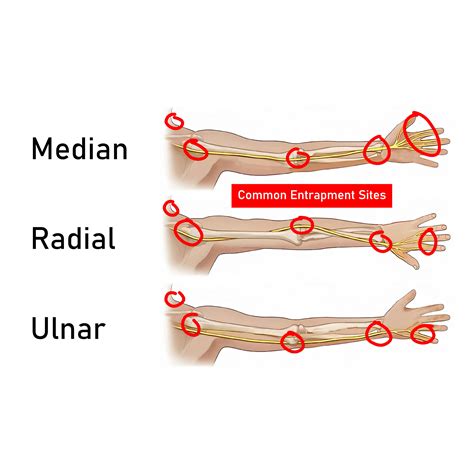 How To Fix Ulnar Nerve Entrapment Causes And Symptoms Gymless