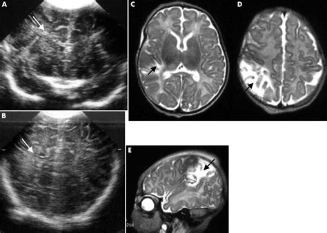 Does Cranial Ultrasound Imaging Identify Arterial Cerebral Infarction