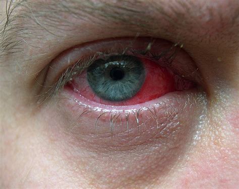 Are you experiencing any of these as new or worsening symptoms? Conjunctivitis - Ten Random Facts