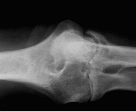 Rheumatoid arthritis (ra) is associated with reduced quality of life, decreased life expectancy, and has an adverse financial impact on the individual and society. Rheumatoid Arthritis of Elbow on X-ray - X Rays Case ...