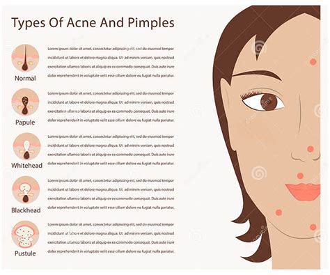 Types Of Acne And Pimples Stock Vector Illustration Of Bacterial