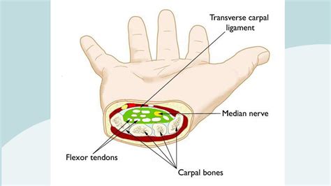 Carpal Tunnel Syndrome And Diabetes
