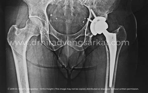 Can A Total Hip Replacement Surgery Help Extend Your Life Dr Nirad
