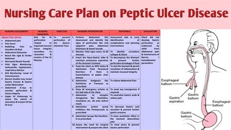 Ncp Nursing Care Plan On Peptic Ulcer Disease Gi Disorders Youtube