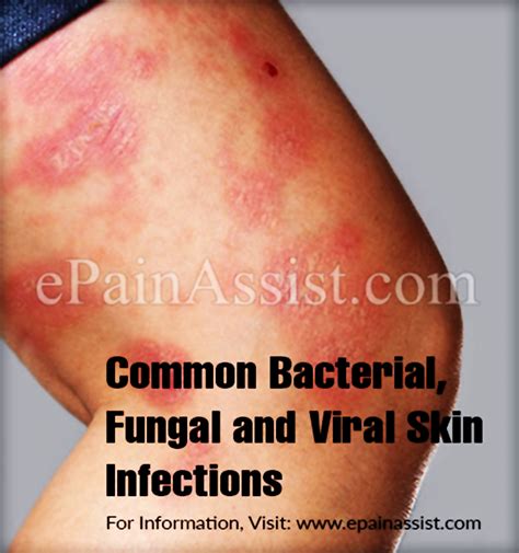 Common Bacterial Fungal And Viral Skin Infections