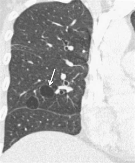 Hrct Image Showing Thin Walled Cysts In The Right Lung Arrow In A