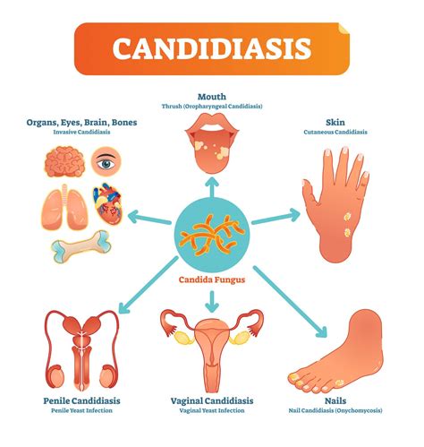 Candida Albicans Effective Candida Treatment With Ibs Clinics