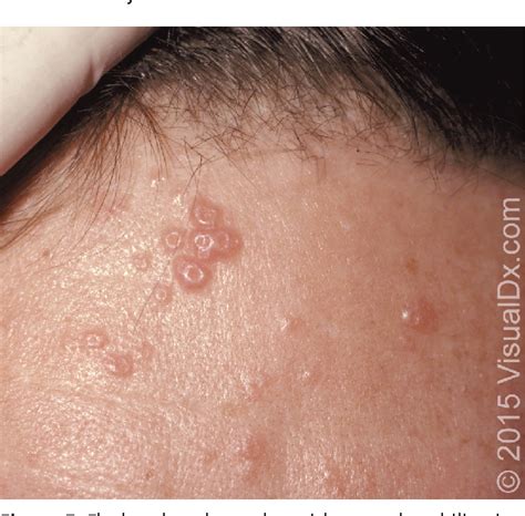 Figure 5 From Common Skin Rashes In Children Semantic Scholar