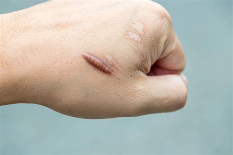 Keloid Scar Treatment In Singapore A Dermatologists Guide Assurance