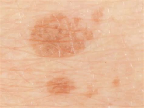 What Causes White Crusty Spots On Skin Canvaaaaaaaa