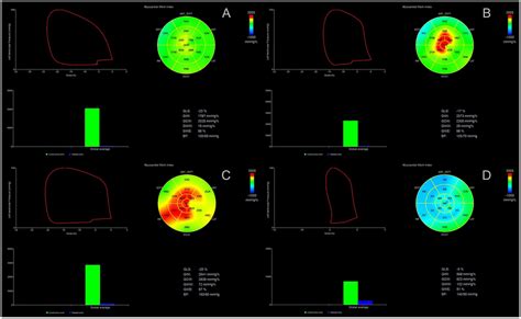 Measurement Of Myocardial Work Indices By 2d Echocardiography