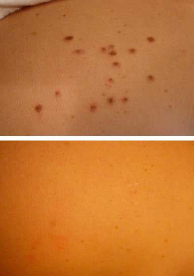 Cherry Angioma Removal Carlisle Instant Results Vl Aesthetics