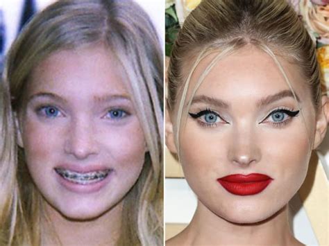 Elsa Hosk Before Plastic Surgery - Elsa Hosk Before and After: From 2005 to 2020 - The Skincare Edit