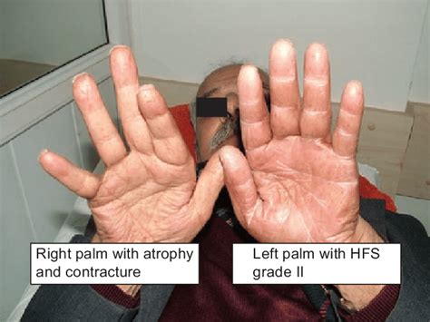 The Patients Hands Showing Unilateral Handfoot Syndrome Hfs
