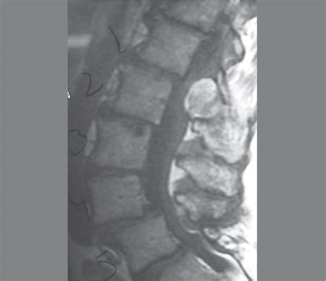 MRI T1weighted Degeneration Of Multiple Lumbar Levels With