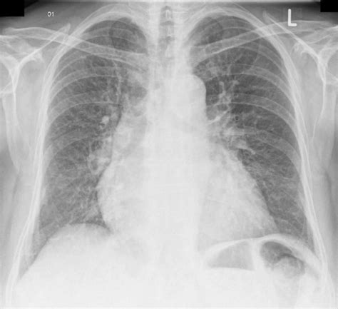 Pulmonary Congestion On Chest X Ray